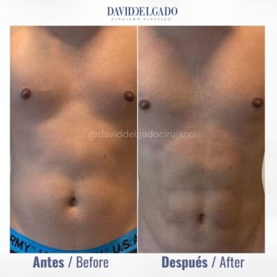 lipomarcación abdominal en Medellín - Dr. David Delgado Cirujano Plástico