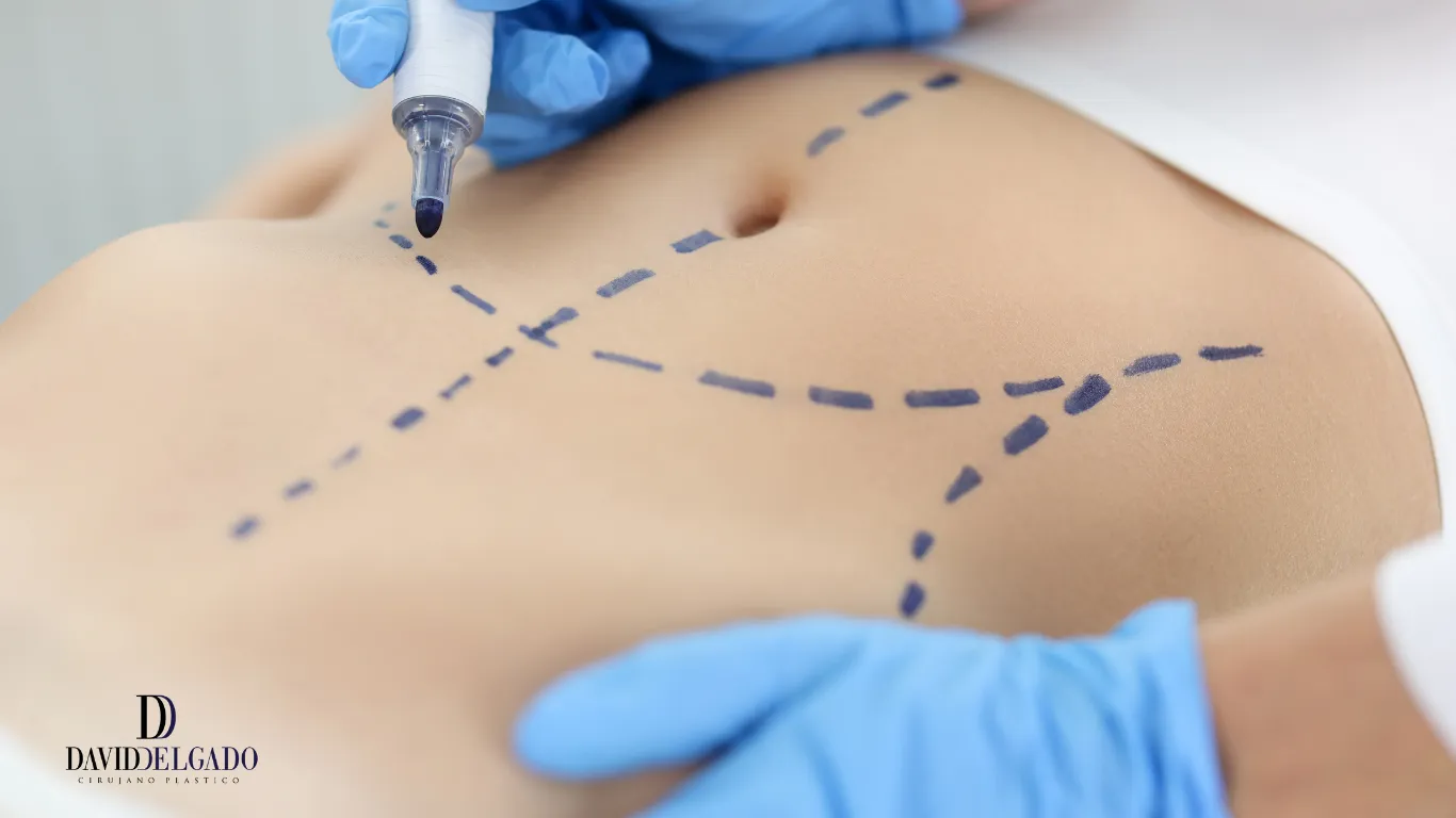 Resultado de contorno corporal - Dr. David Delgado Medellín