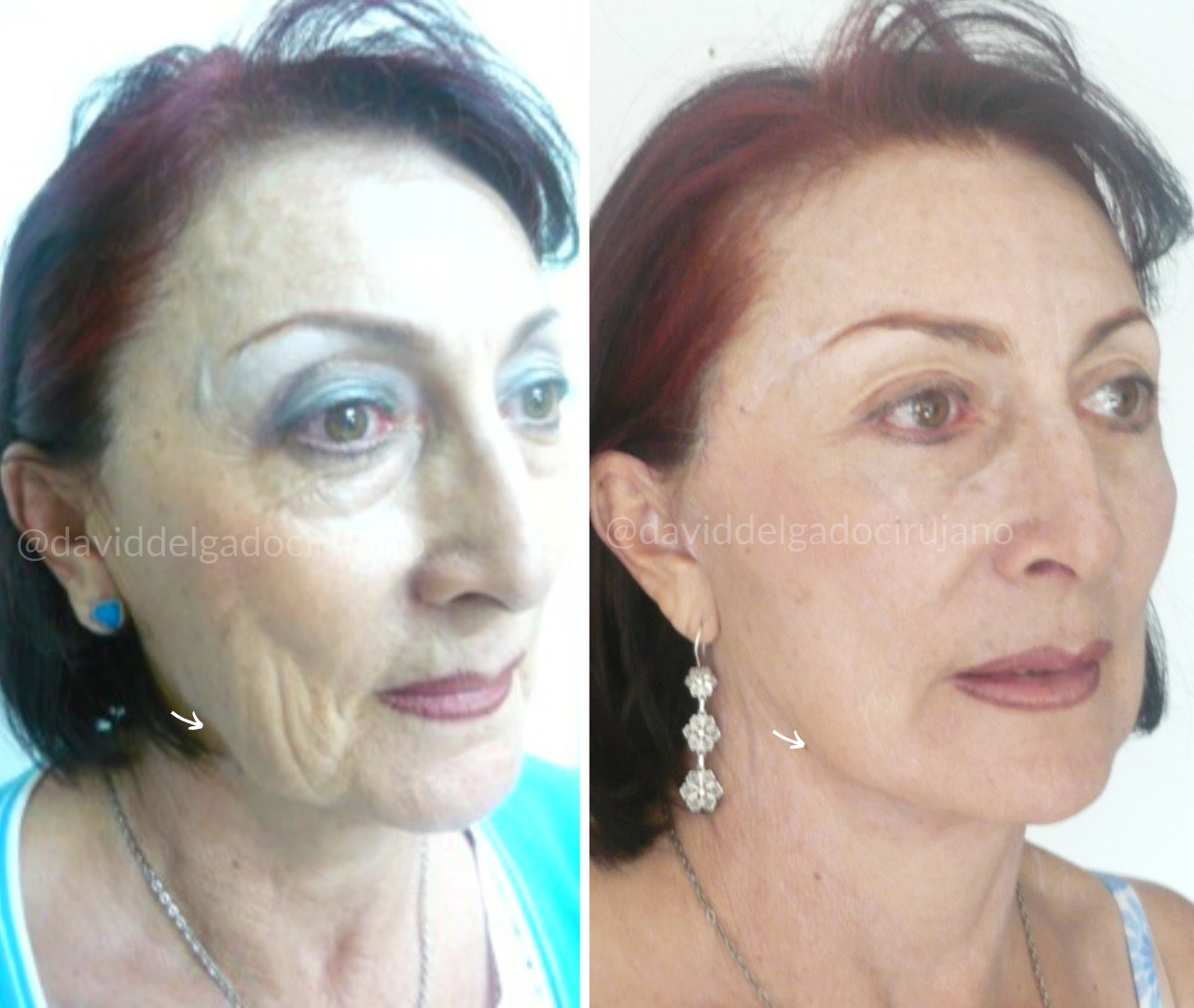 Ritidoplastia – Rejuvenecimiento Facial | Dr David Delgado