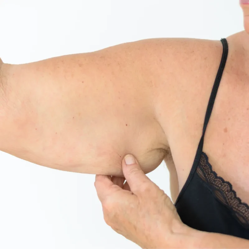 Braquioplastia: resultado de cirugía de brazos en Medellín