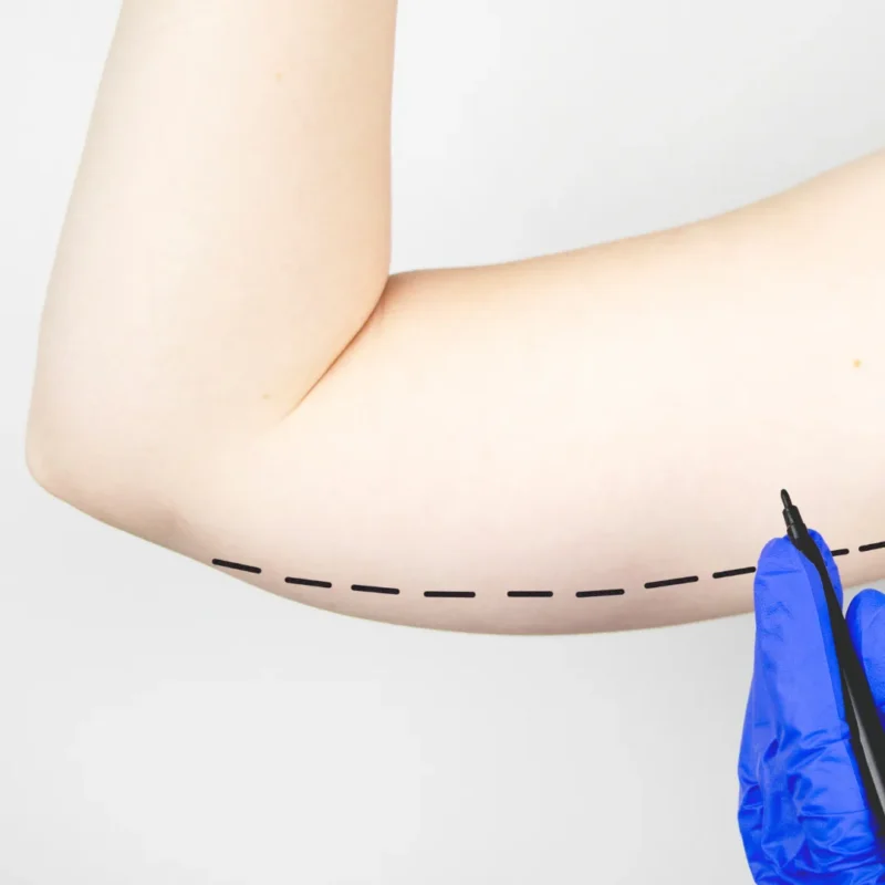 Cirugía plástica de brazos (braquioplastia) — Dr. David Delgado