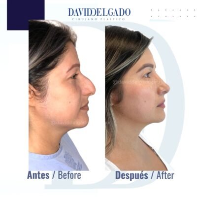 Rhinoplasty