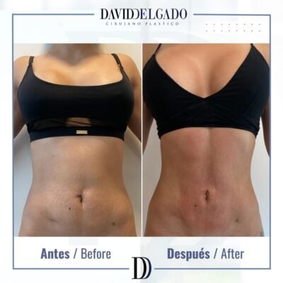 ANTES BEFORE liposucción