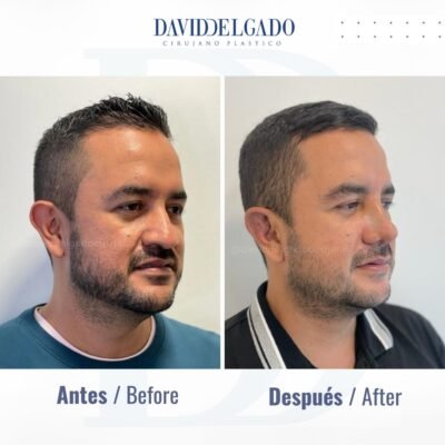 RHINOPLASTY in Colombia