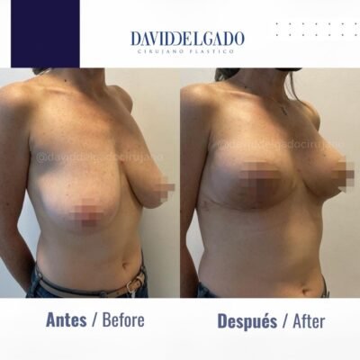 BREAST AUGMENTATION