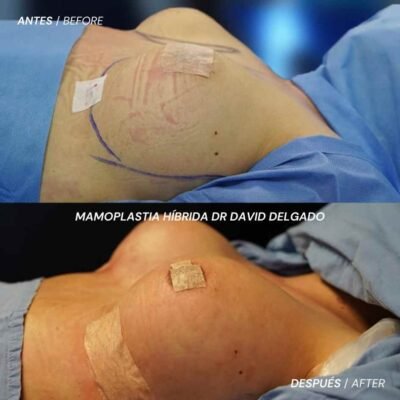 ANTES Y DESPUÉS MAMOPLASTIA HÍBRIDA