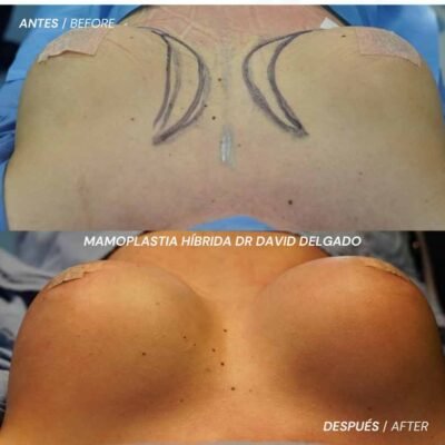 ANTES Y DESPUÉS MAMOPLASTIA HÍBRIDA