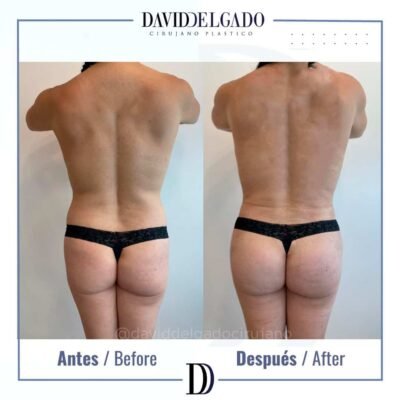 Dr. David Delgado Brazilian butt lift 3
