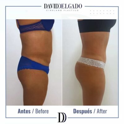 Dr. David Delgado Brazilian butt lift 4