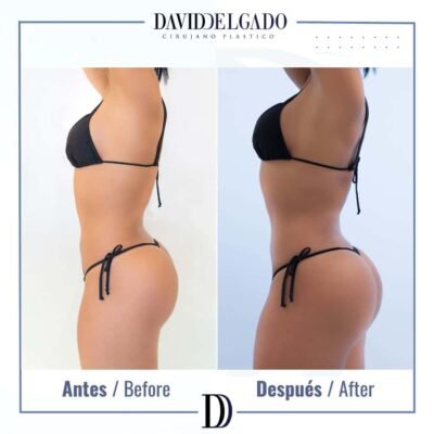 Dr. David Delgado Brazilian butt lift 8
