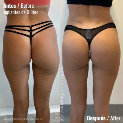 Gluteoplastia