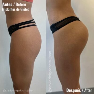Gluteoplastia