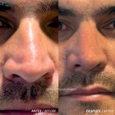 Antes y después Rinoplastia Hombre Dr. David Delgado