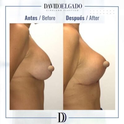 Breast lift without implants Dr David Delgado Plastic Surgeon Medellín Colombia