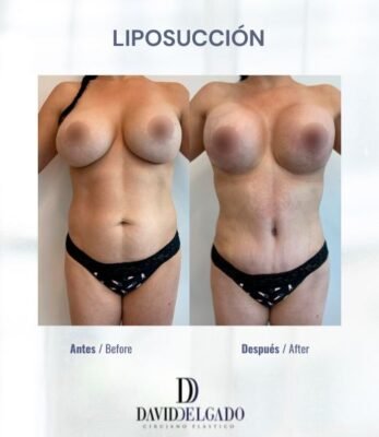 Lipo in Colombia Dr. David Delgado Best Plastic Surgeon in Medellín