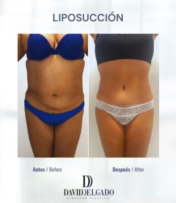 Lipo in Colombia Dr. David Delgado Best Plastic Surgeon in Medellín