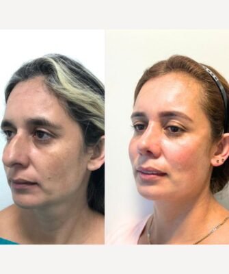 Rejuvenecimiento Facial Dr David Delgado Mejor Cirujano Plástico En Medellín