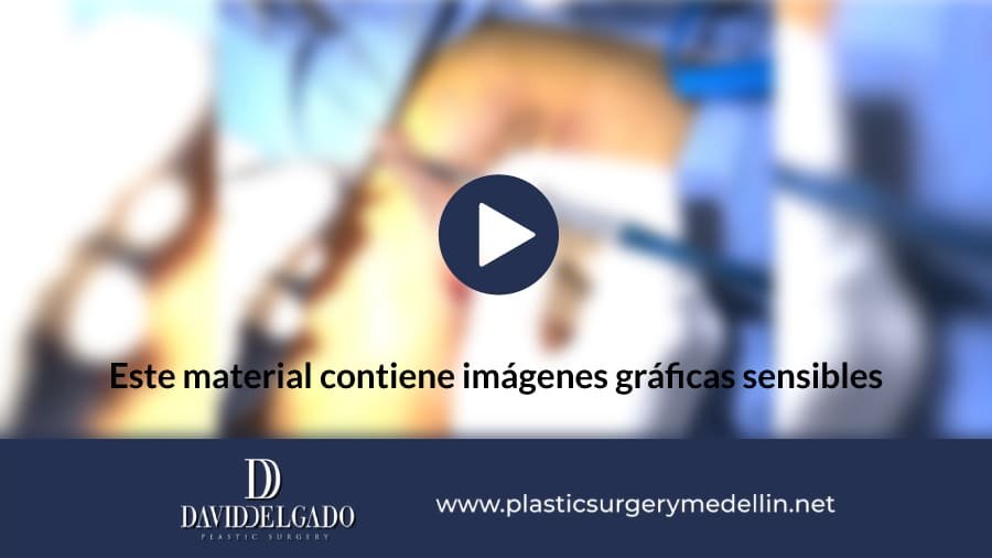 Cirugía-Plástica-Vaginal - -Dr.-David-Delgado-Cirujano-Plástico