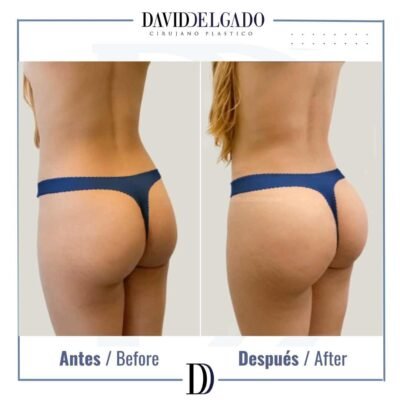 Gluteoplastia antes y después