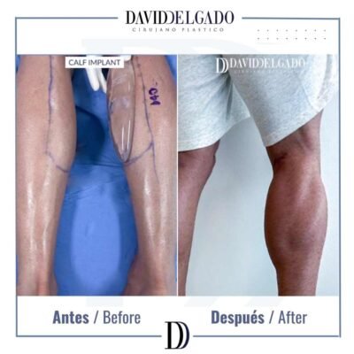 Implante de pantorrilla antes y después