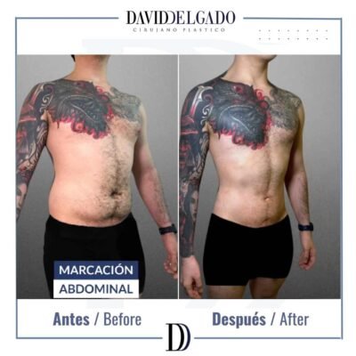 MArcación abdominal antes y después