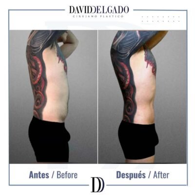 Marcación abdominal fotos