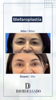 Blefaroplastia Medellín