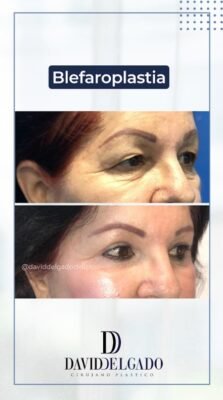 Blefaroplastia precio medellín