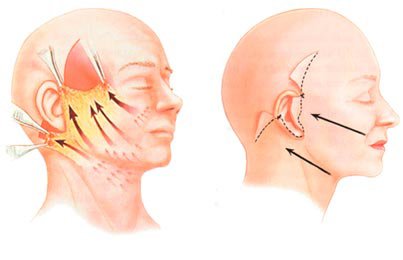 Ritidoplastia procedimiento - Dr. David Delgado - Cirujano Plástico en Medellín