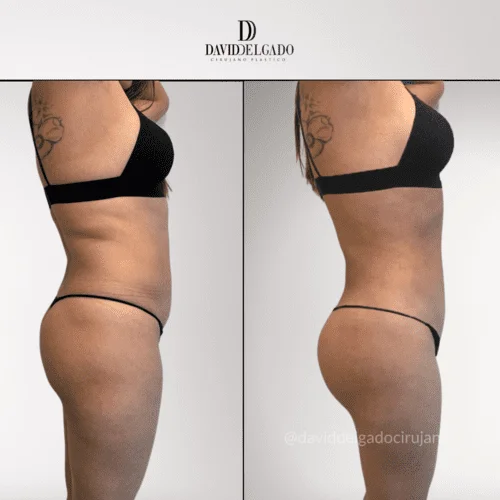 Sculpt Your Sides: Dr. David Delgado’s Expertise in love handles surgery – Flank Liposuction