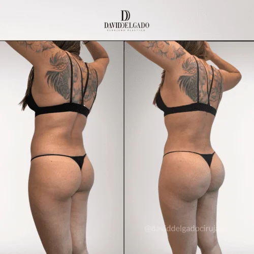 Sculpt Your Sides: Dr. David Delgado’s Expertise in love handles surgery – Flank Liposuction