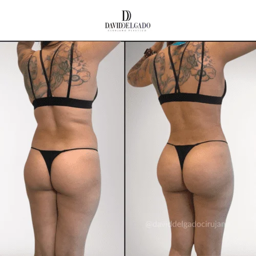 Sculpt Your Sides: Dr. David Delgado’s Expertise in love handles surgery – Flank Liposuction