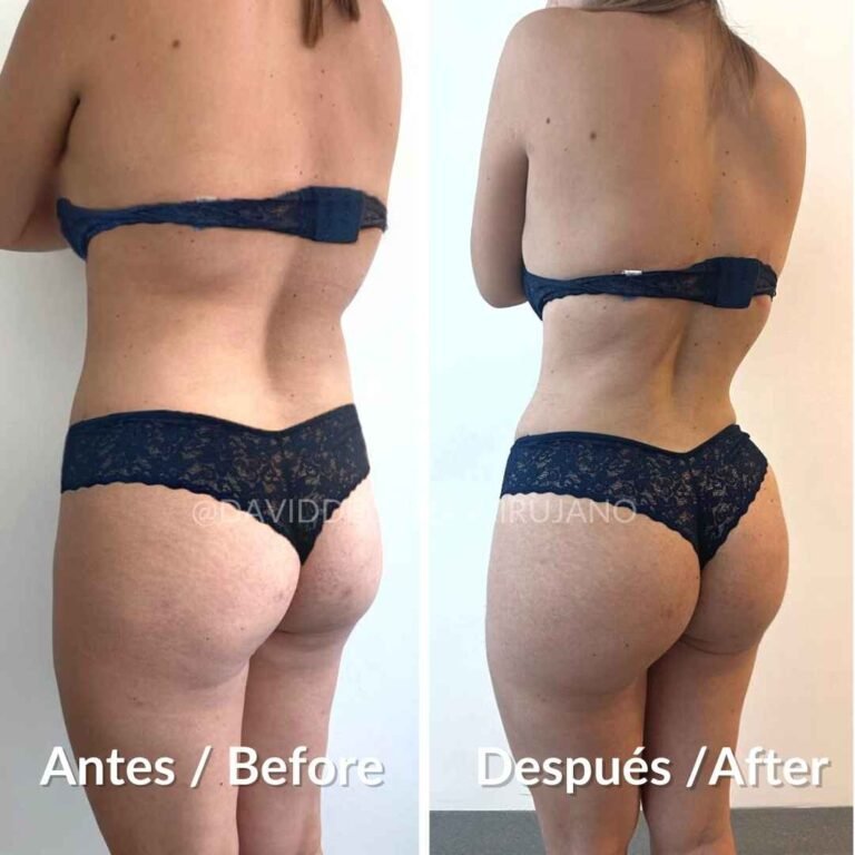 Sculpt Your Sides: Dr. David Delgado’s Expertise in love handles surgery – Flank Liposuction