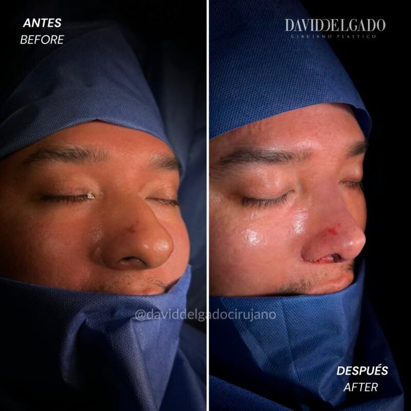 Caso de Antes y después de Rinoplastia Ultrasónica con el Dr David Delgado