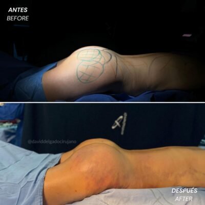 Caso de Antes y después de Gluteoplastia con el Dr David Delgado