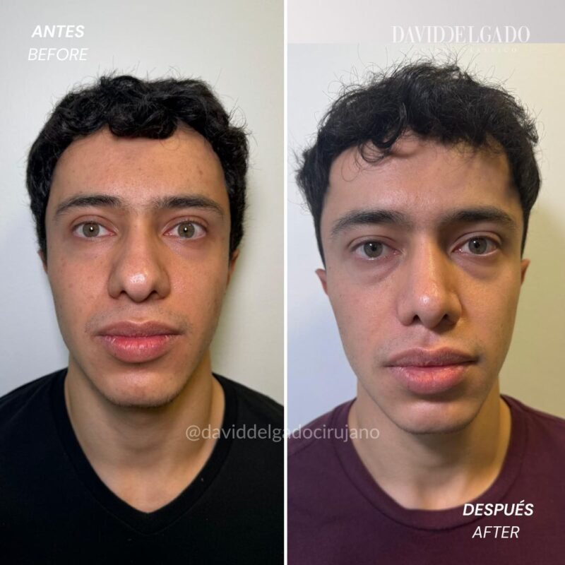 Caso de Antes y después de Rinoplastia Ultrasónica con el Dr David Delgado