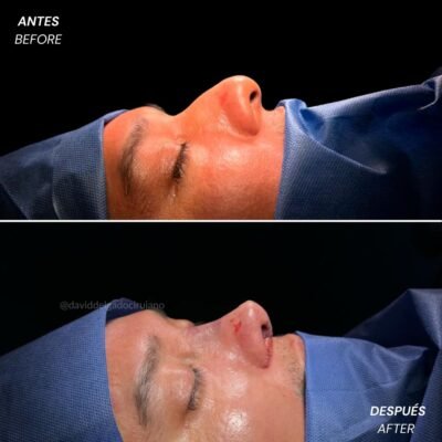 Caso de Antes y después de Rinoplastia Ultrasónica con el Dr David Delgado