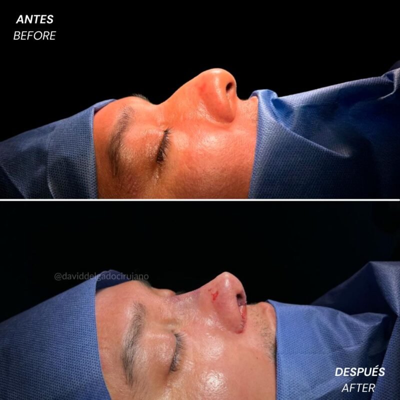 Caso de Antes y después de Rinoplastia Ultrasónica con el Dr David Delgado