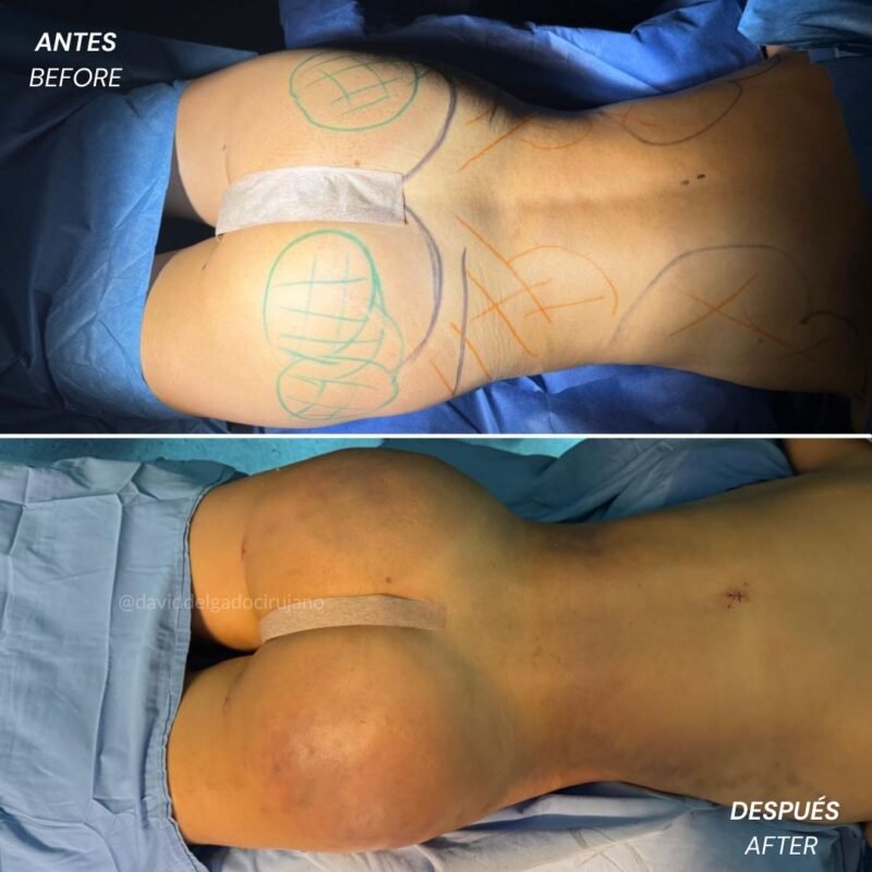 Caso de Antes y después de Gluteoplastia con el Dr David Delgado