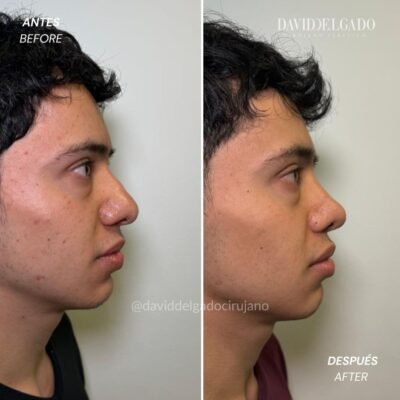 Caso de Antes y después de Rinoplastia Ultrasónica con el Dr David Delgado
