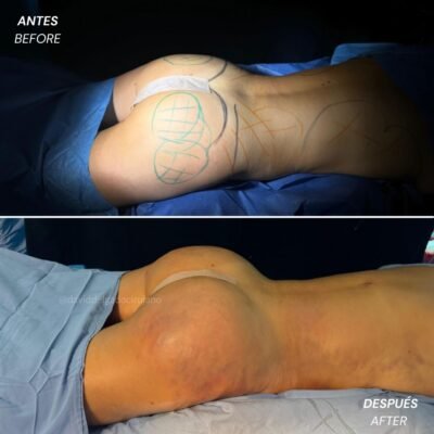 Caso de Antes y después de Gluteoplastia con el Dr David Delgado