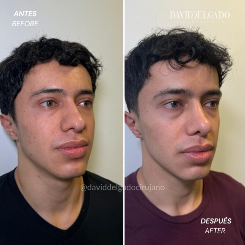 Caso de Antes y después de Rinoplastia Ultrasónica con el Dr David Delgado