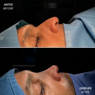 Caso de Antes y después de Rinoplastia Ultrasónica con el Dr David Delgado