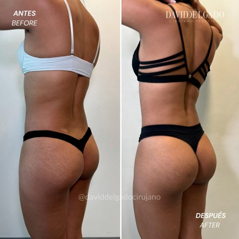 Antes y después liposucción