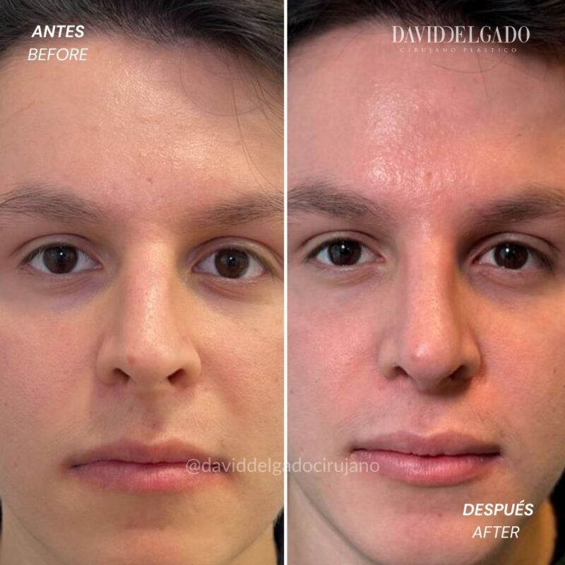 Caso de Antes y después de Rinoplastia con el Dr David Delgado