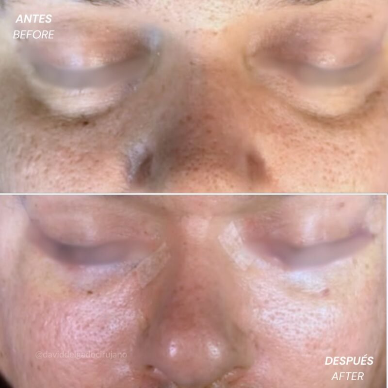 Antes y después Blefaroplastia Cirugía de parpados con el Dr David Delgado mejor cirujano plástico de Medellín Colombia