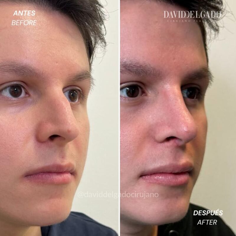 Caso de Antes y después de Rinoplastia con el Dr David Delgado