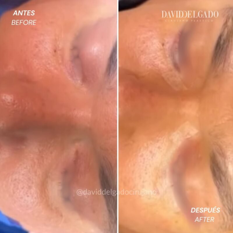 Antes y después Blefaroplastia Cirugía de parpados con el Dr David Delgado mejor cirujano plástico de Medellín Colombia