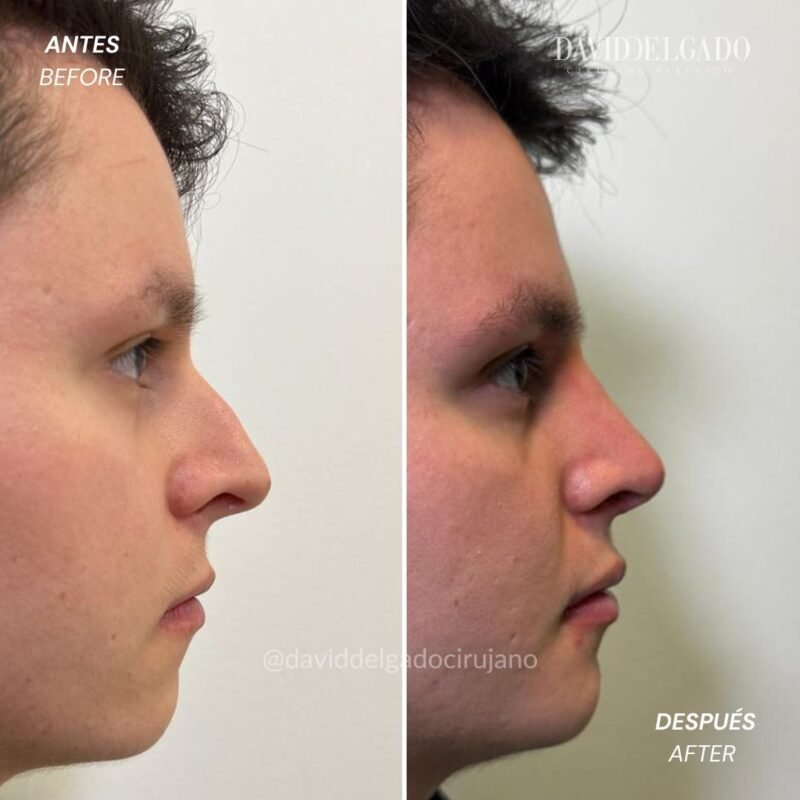 Caso de Antes y después de Rinoplastia con el Dr David Delgado