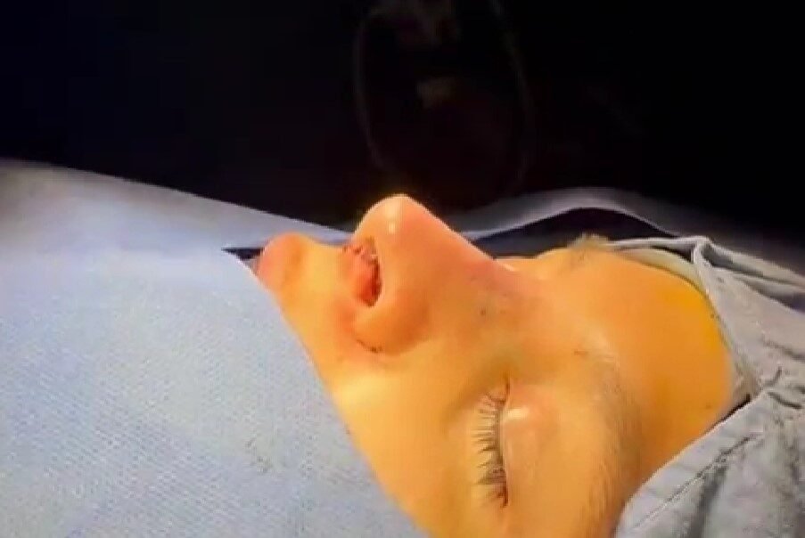 Cicatriz de una rinoplastia